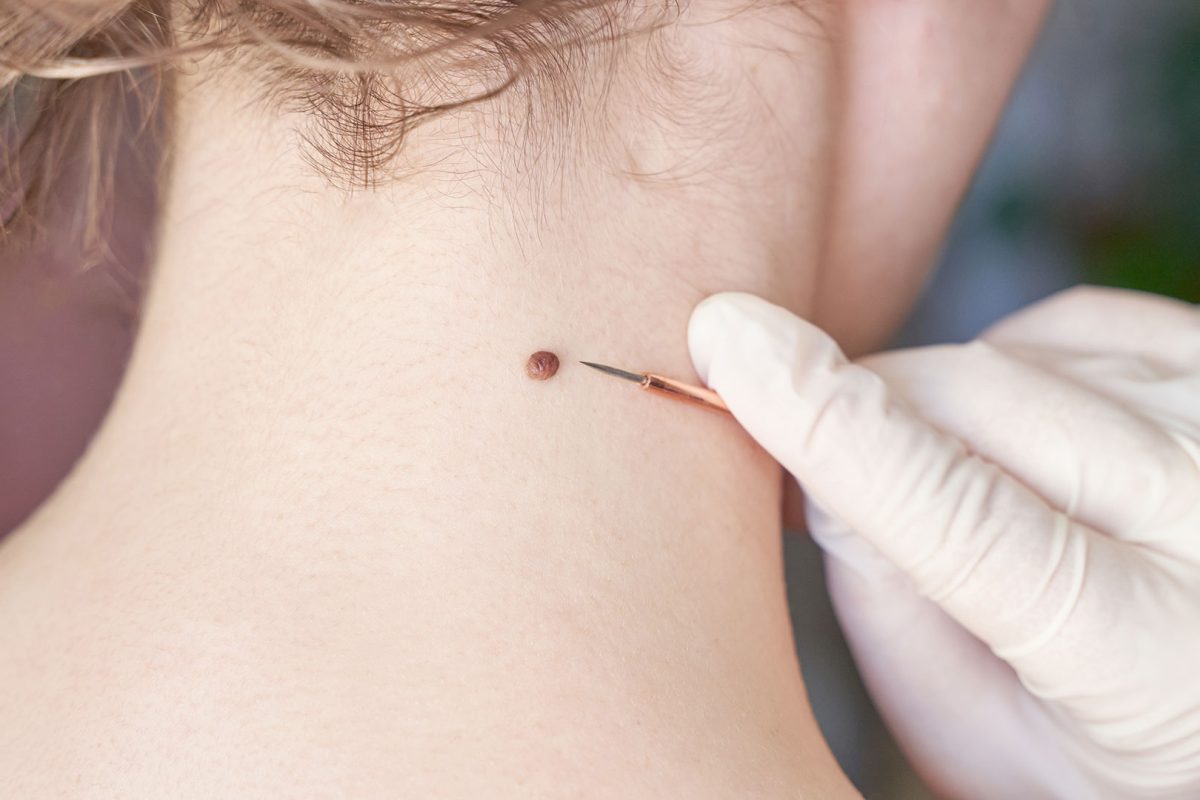 Besplatni preventivni pregledi madeža Besplatni preventivni pregledi madeža