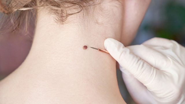 Besplatni preventivni pregledi madeža